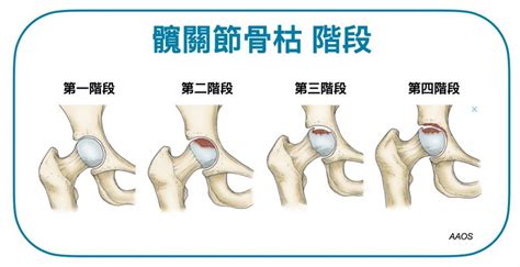 骨枯手術費用|【髖關節手術費用2023】公私營醫院收費參考